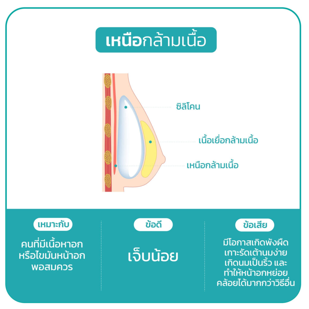 ศัลยกรรม เสริมหน้าอก เทคนิค ผ่าตัดเหนือกล้ามเนื้อ