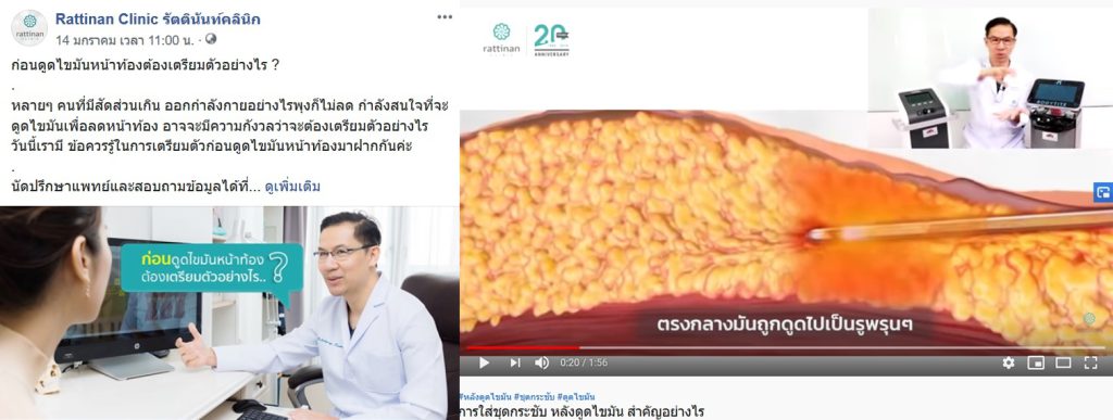 ดูดไขมัน ต้องเตรียมตัวอย่างไร