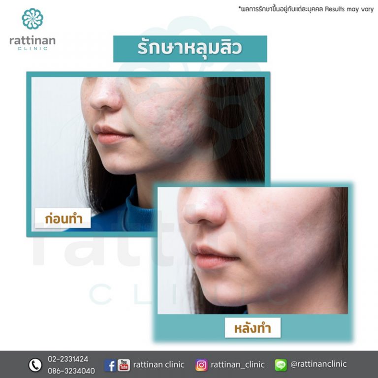 รีวิวรักษาหลุมสิว e-matrix ที่รัตตินันท์ เมดิคอล เซ็นเตอร์