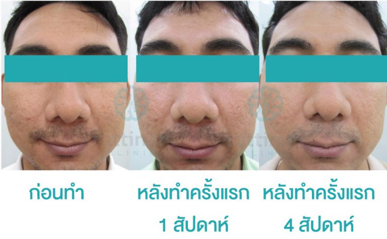 รีวิวรักษาหลุมสิว e-matrix