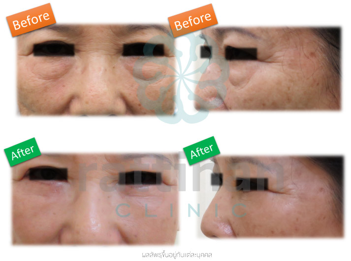 วิธีรักษา ถุงใต้ตา eye bag surgery