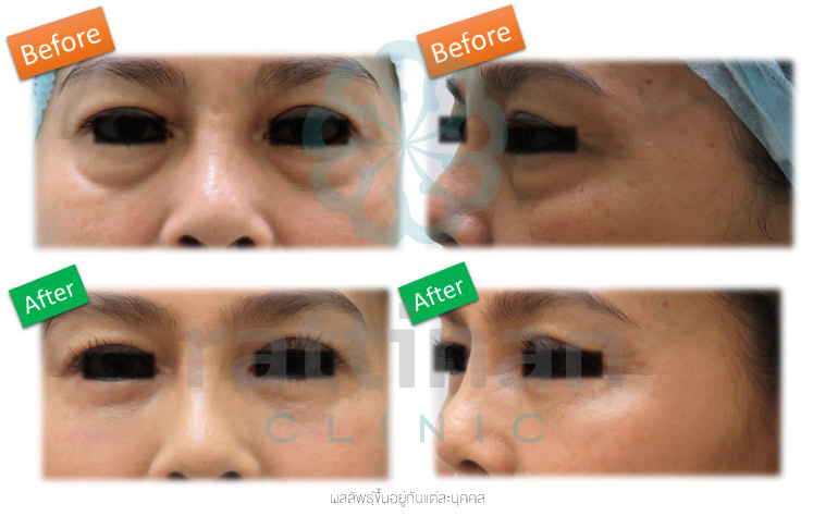 eye bag surgery ถุงใต้ตา รักษาอย่างไร