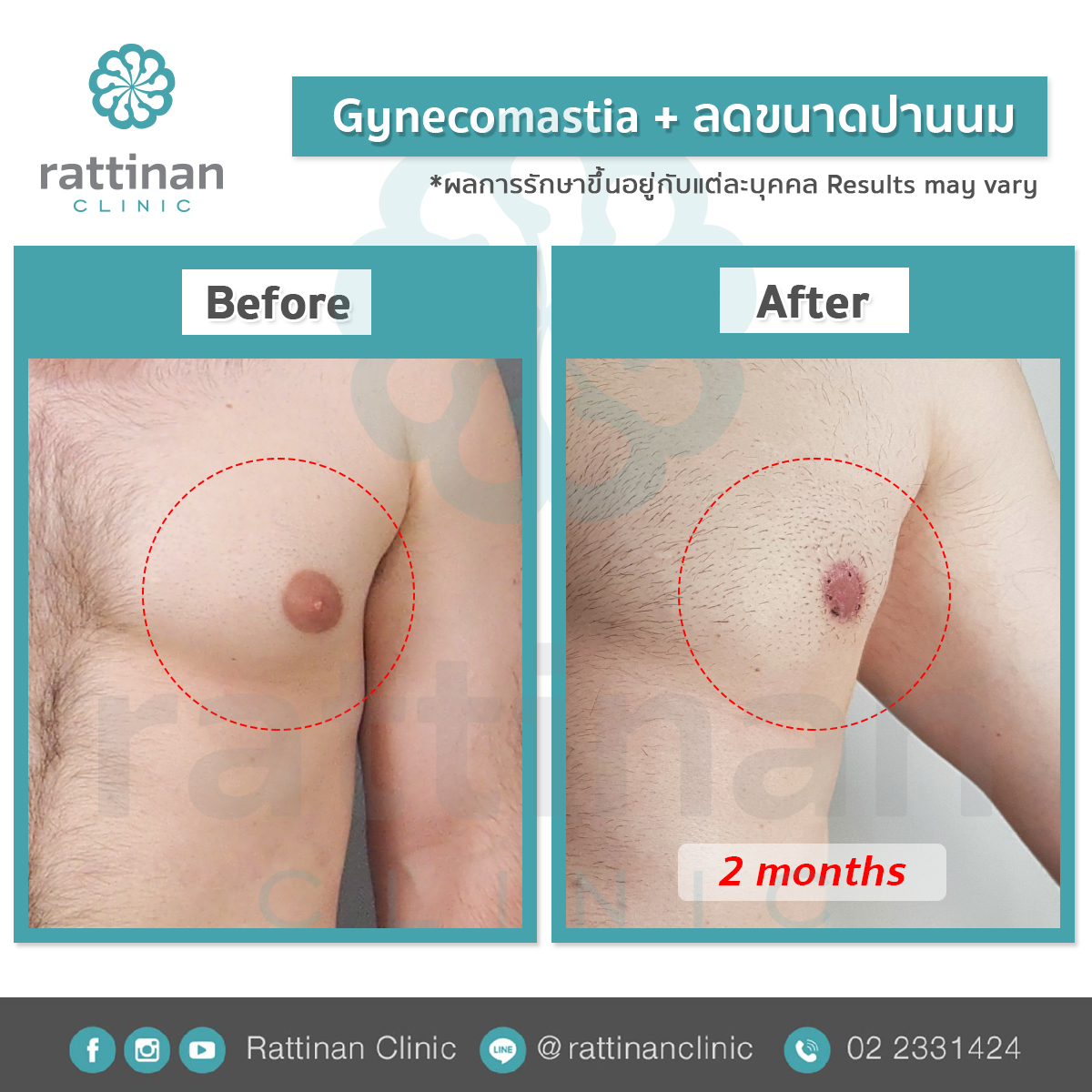 gynecomastia รัตตินันท์