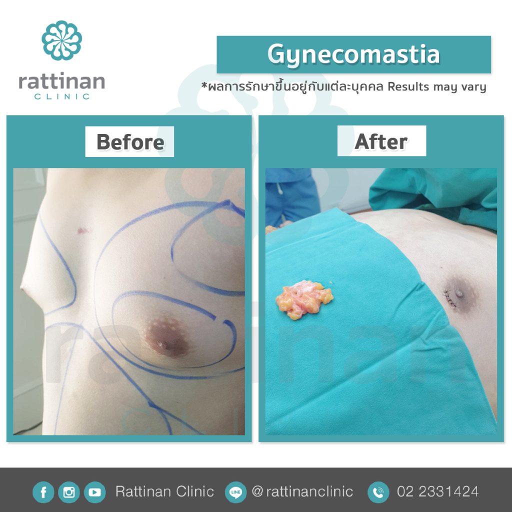 รีวิว gynecomastia ที่รัตตินันท์