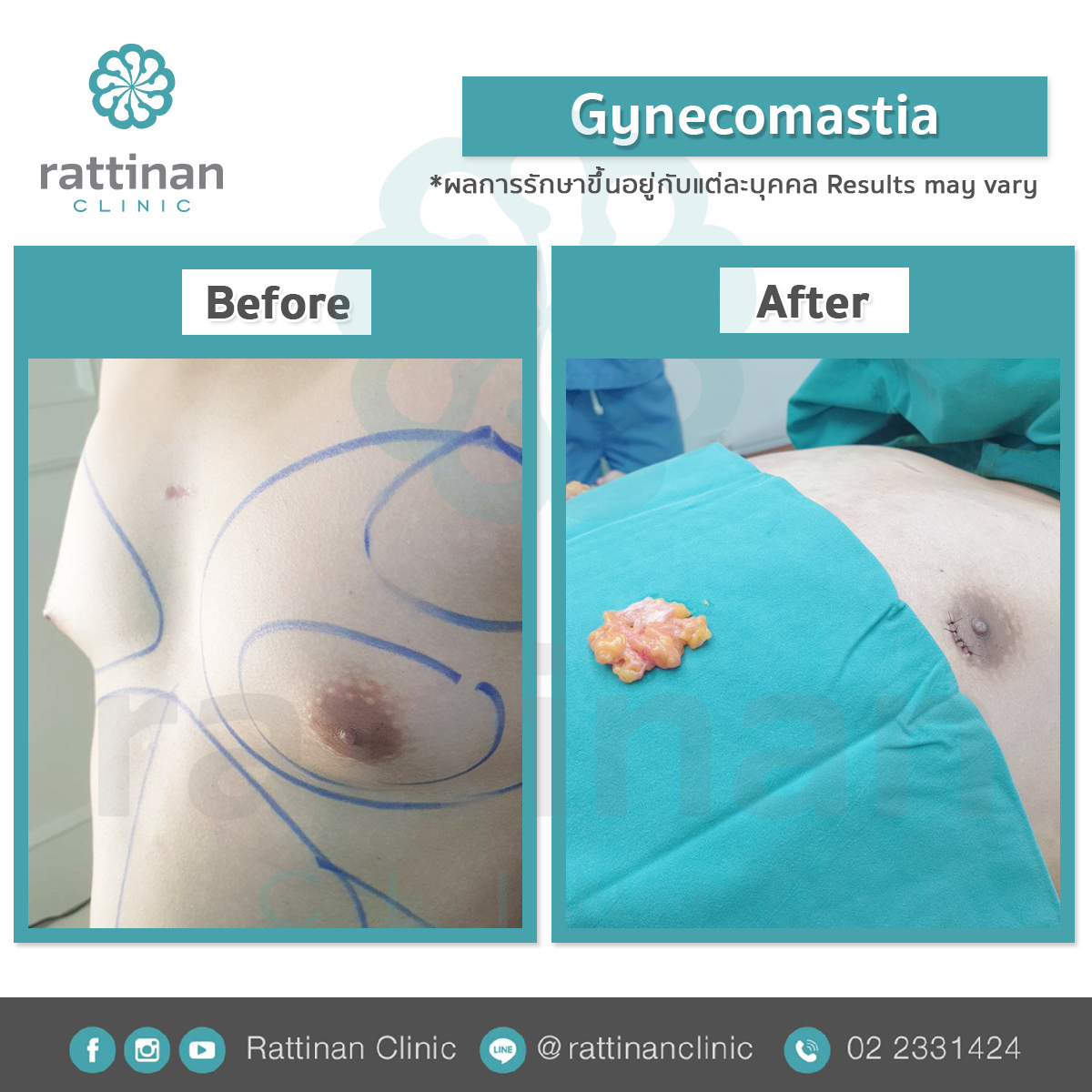 รีวิว gynecomastia ที่รัตตินันท์