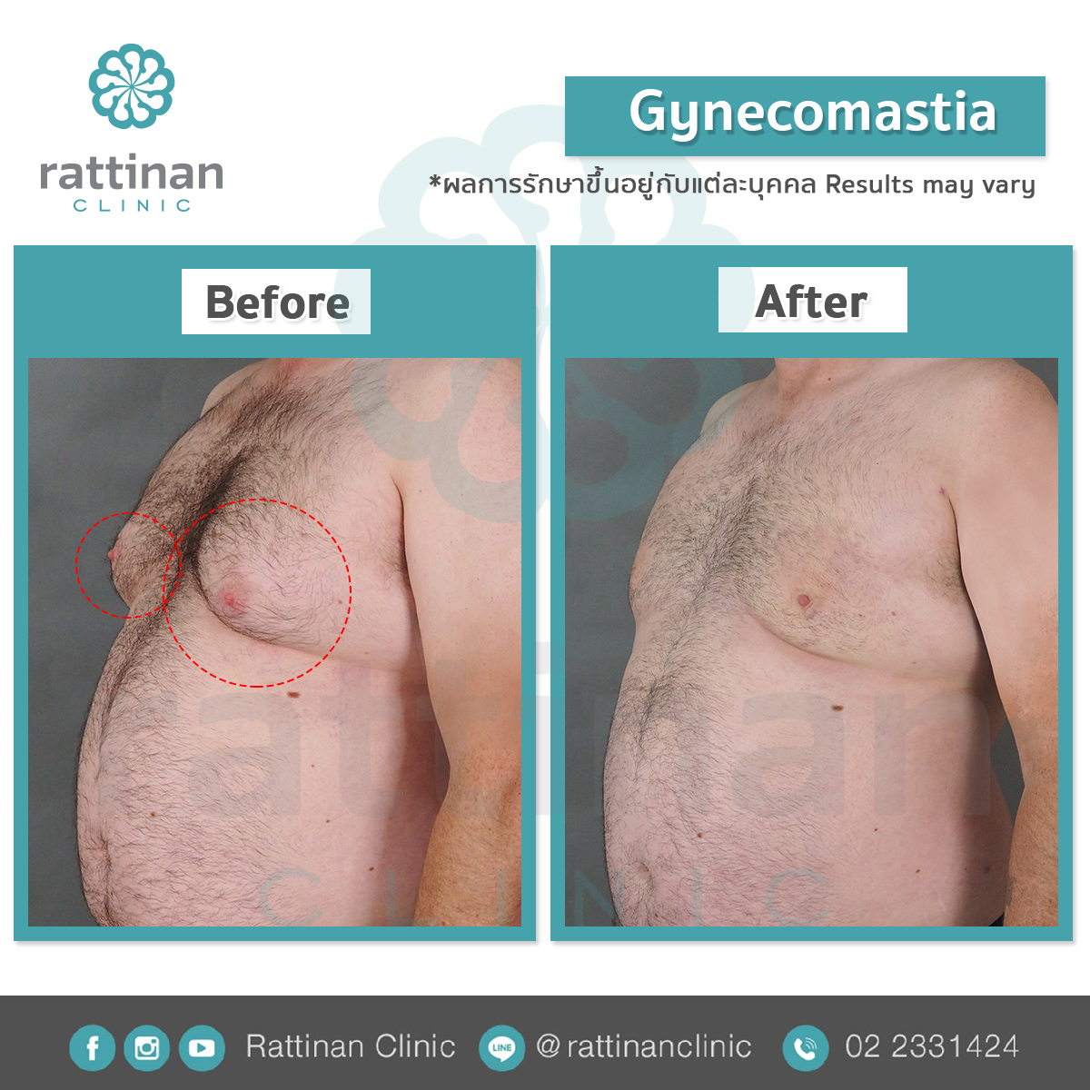 รีวิว gynecomastia รักษาเต้านมโตผู้ชาย