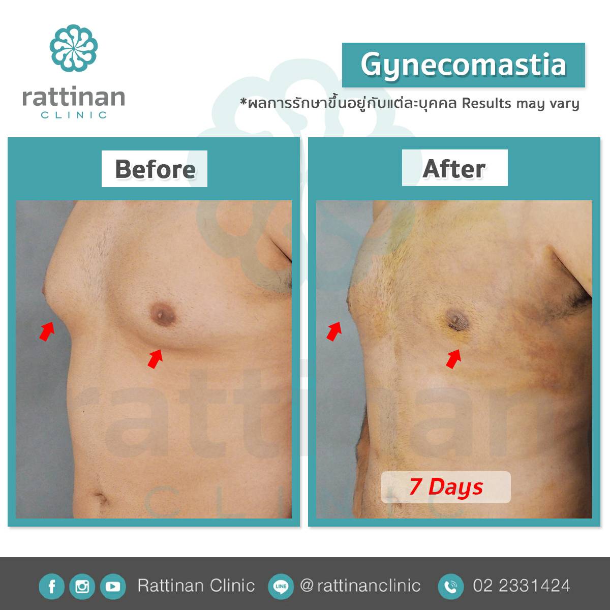 รีวิว gynecomastia