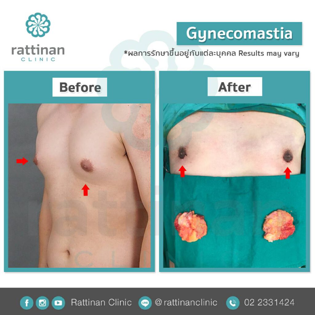 รีวิวตัดเต้านมผู้ชาย ผู้ชานนมแหลม gynecomastia รัตตินันท์ เมดิคอล เซ็นเตอร์