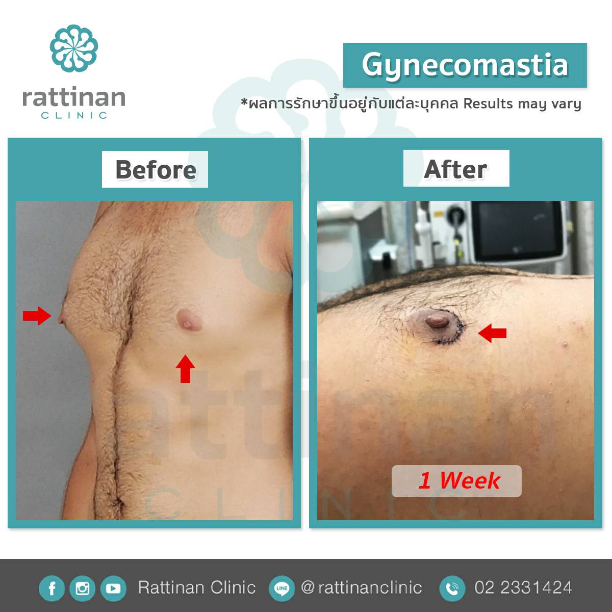 รีวิว gynecomastia เทคนิคซ่อนแผล เฉพาะรัตตินันท์ เมดิคอล เซ็นเตอร์