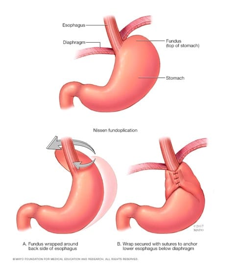 Nissen fundoplication หรือการผ่าตัด Nissen