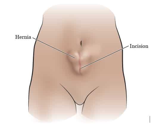 ไส้เลื่อน บริเวณแผลผ่าตัด (incisional hernia)