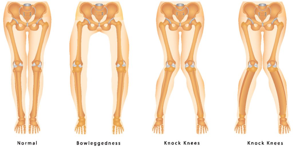 ขาโก่ง ขาฉิ่ง (kock-knee) เกิดจากอะไร อันตรายจหรือไม่ และรักษาอย่างไร