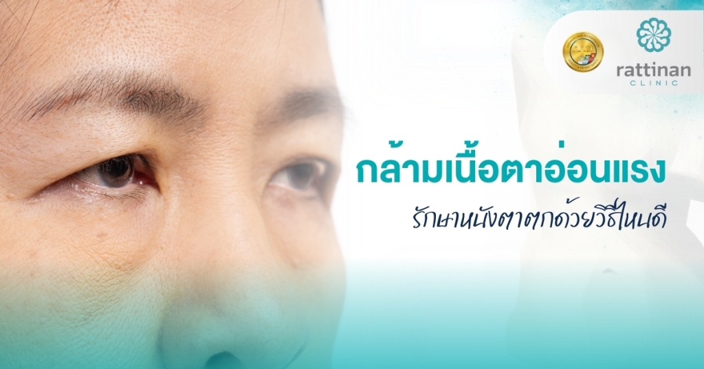 กล้ามเนื้อตาอ่อนแรง
