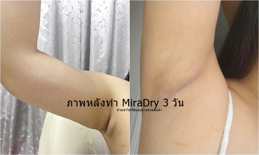 รีวิวการทำ miradry หลังผ่านไป 3 วัน