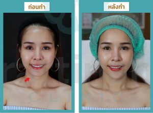 รีวิวเติมฟิลเลอร์ใต้ตา