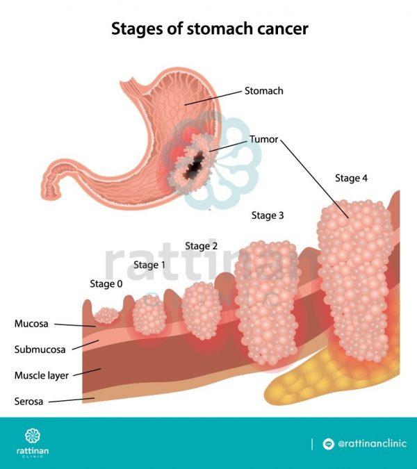มะเร็งกระเพาะอาหาร เกิดจากอะไร