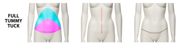 ตัดหนังหน้าท้อง แบบ full tummy tuck