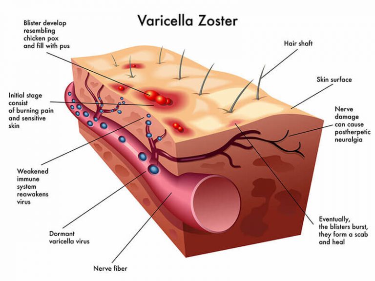 งูสวัด Shingles เกิดจากอะไร