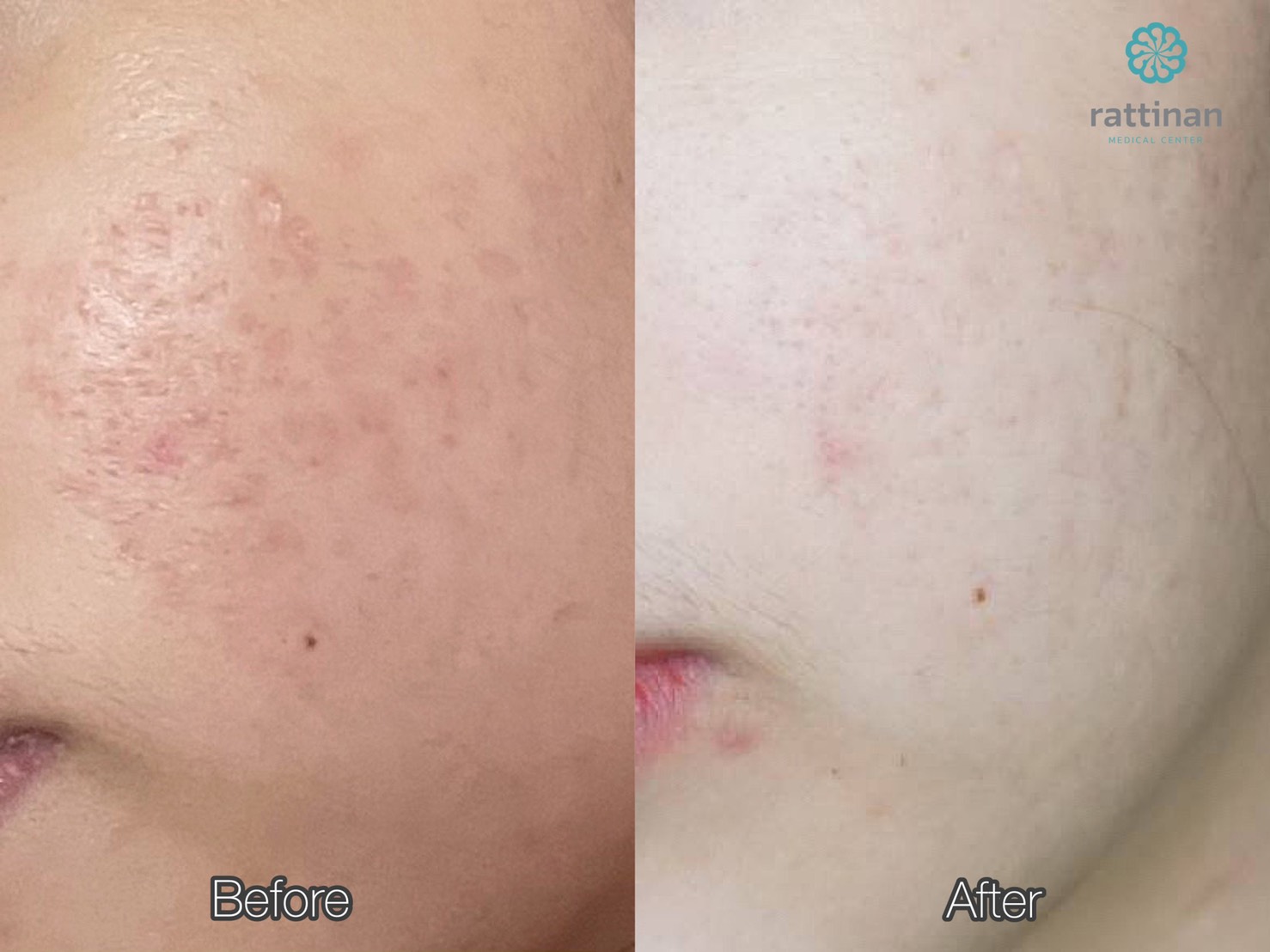 รีวิว picsecond laser รักษาหลุมสิว