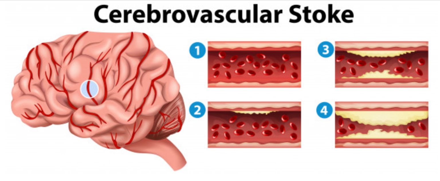 Stroke stroke