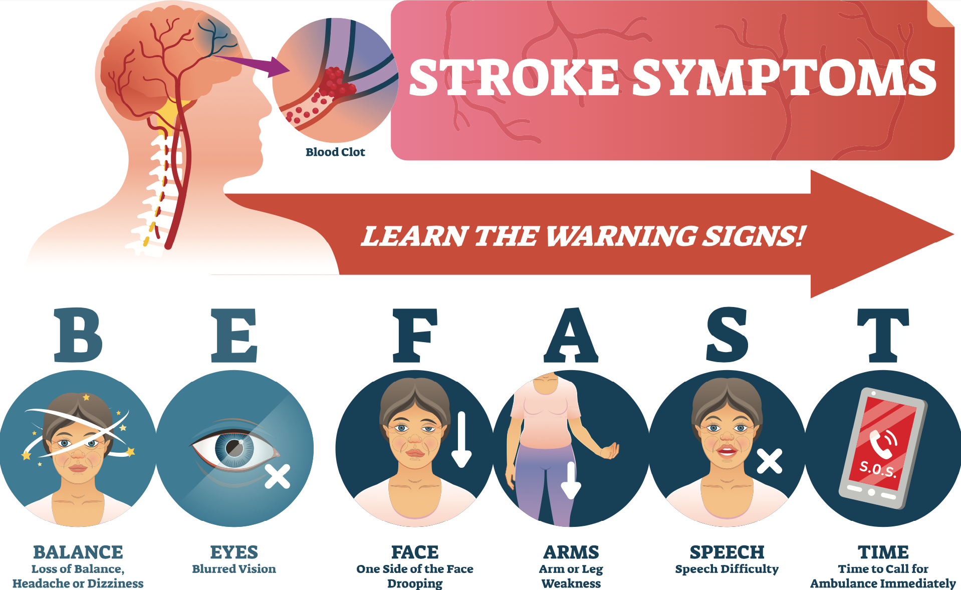 อาการ โรคหลอดเลือดสมอง หรือ Stroke