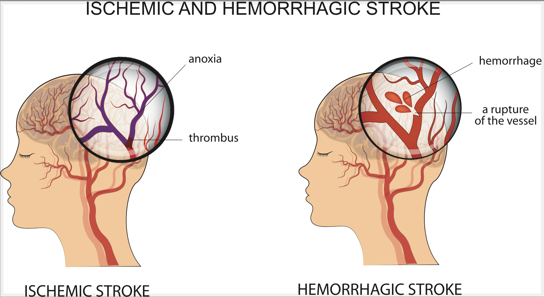 โรคหลอดเลือดสมอง หรือ Stroke มีกี่ประเภท