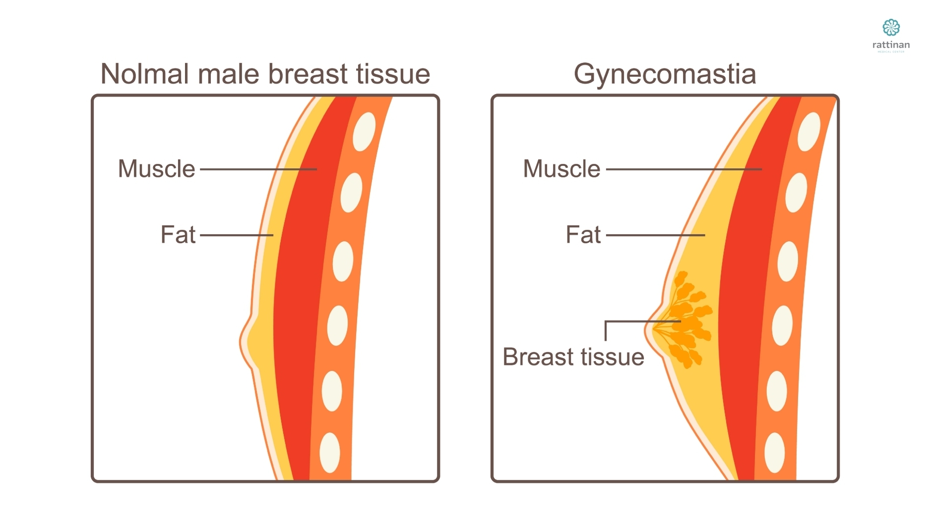 gynecomastia มีลักษณะอย่างไร