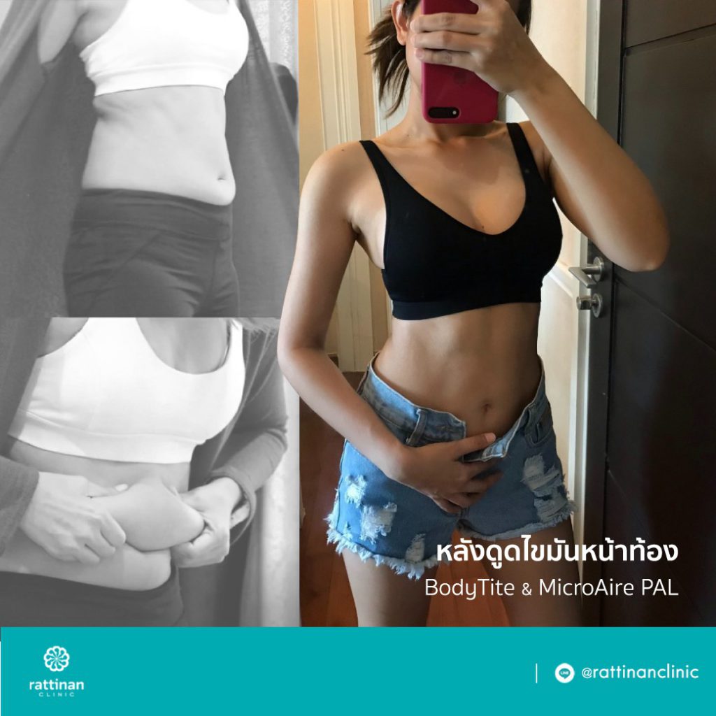 รีวิว ดูดไขมันเอว พร้อมดูดไขมันหน้าท้อง sexy line