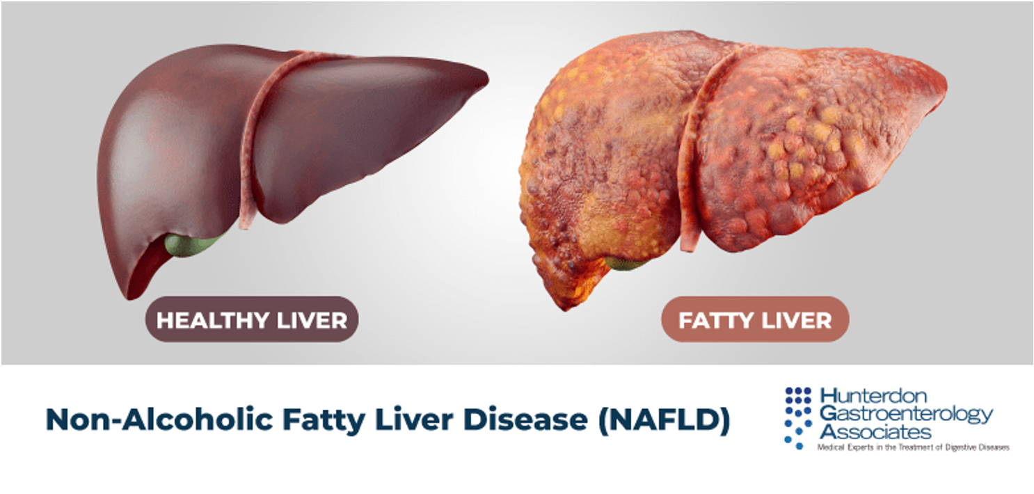 ไขมันพอกตับ (fatty liver disease)