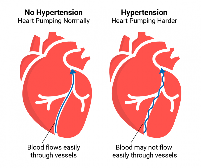hypertension