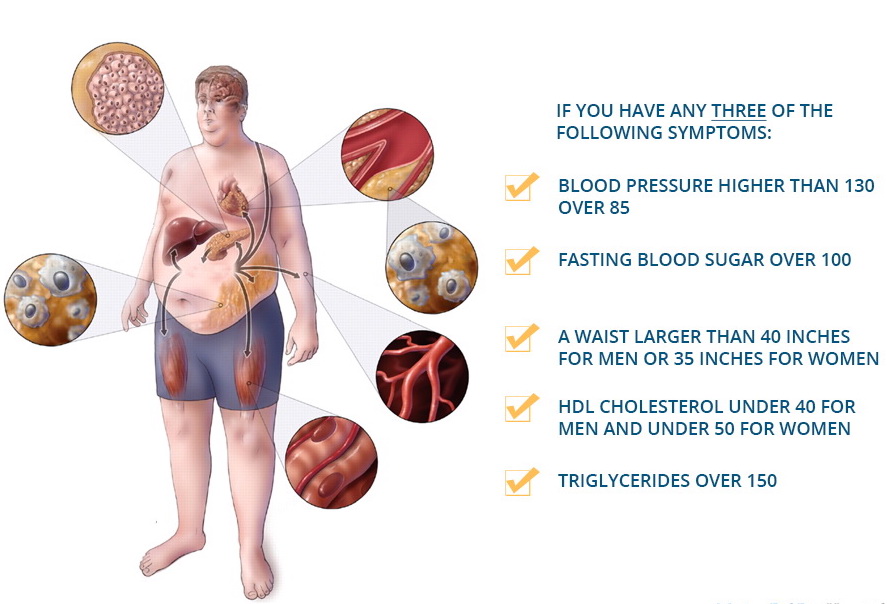 ภาวะ อ้วนลงพุง (Metabolic Syndrome)