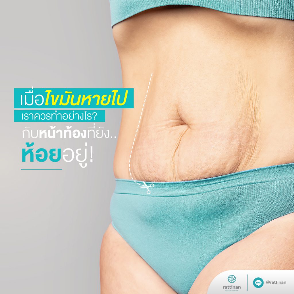 ไขมันส่วนเกินหน้าท้อง หน้าท้องหย่อนยาน แก้ไขยังไงดี? - Tummy Tuck