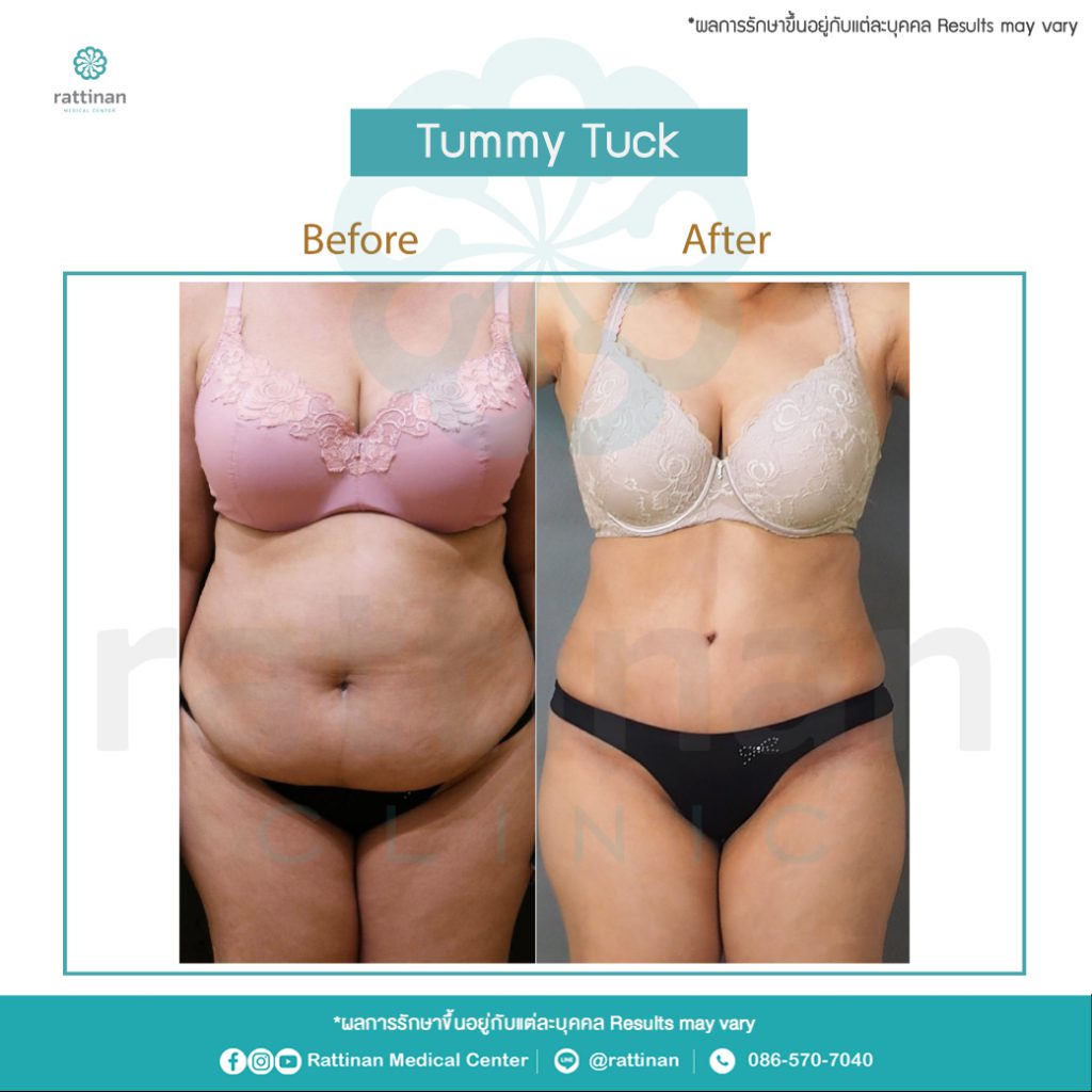 รีวิวตัดหนังหน้าท้อง คุณแม่หลังคลอด (tummy tuck)