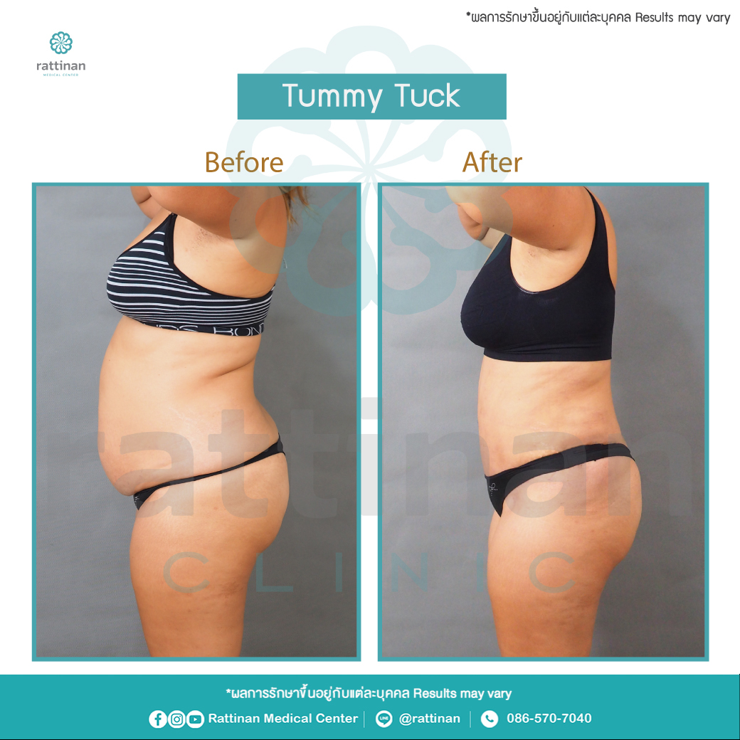 รีวิวตัดหนังหน้าท้อง tummu tuck