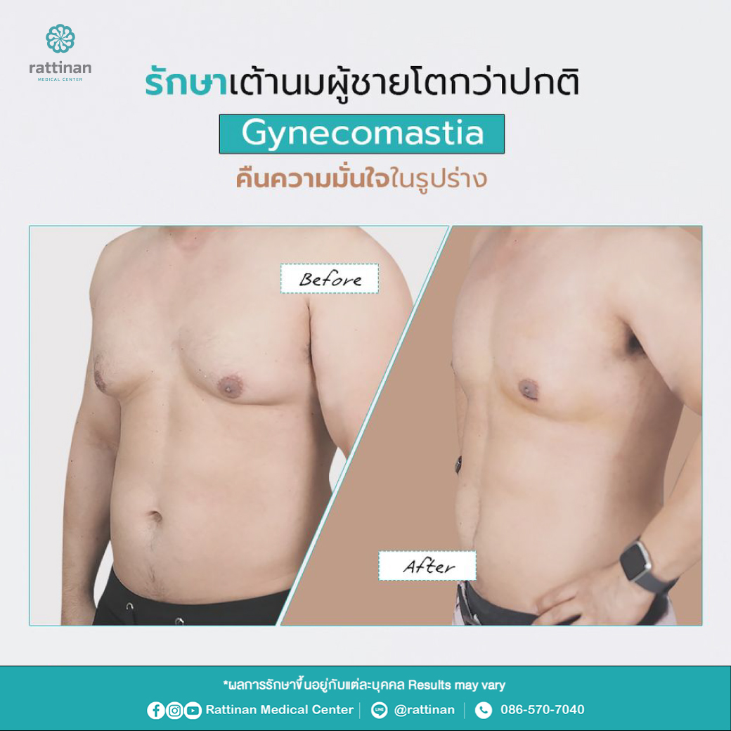 รักษาเต้านมโตผู้ชาย ลดขนาดเต้านมผู้ชาย Gynecomastia