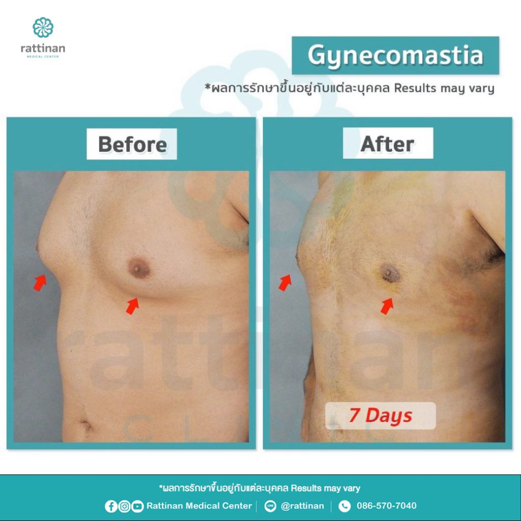 รีวิว รักษาเต้านมโตผู้ชาย ลดขนาดเต้านมผู้ชาย Gynecomastia