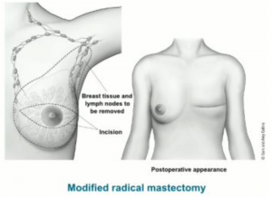 ผ่าตัดเต้านม ผู้ป่วย โรคมะเร็ง ต่างกับ การผ่าตัดนมทอม