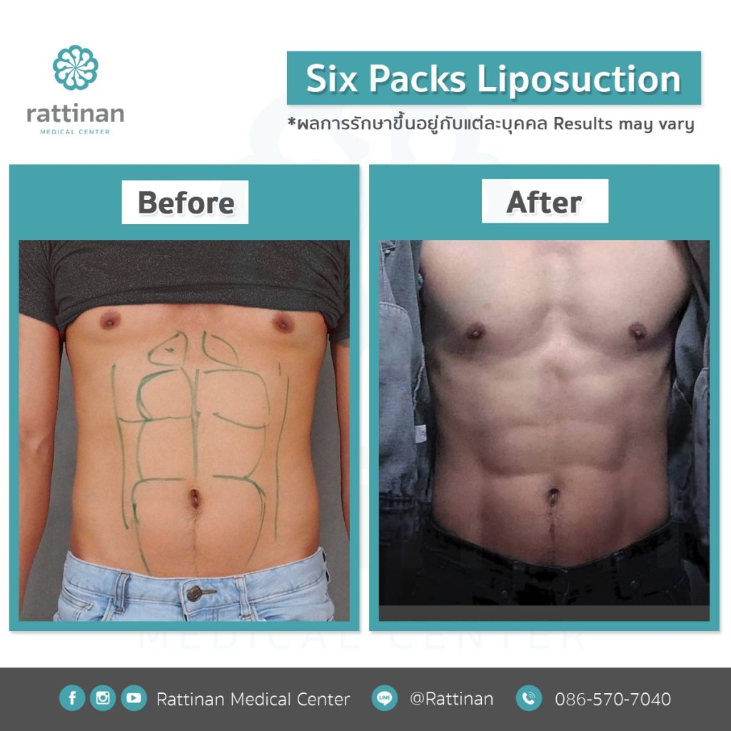 ดูดไขมันซิกแพค sixpack liposuction ที่รัตตินันท์ เมดิคคอล เซ็นเตอร์ 2