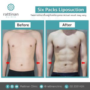ดูดไขมันซิกแพค sixpack liposuction ที่รัตตินันท์ เมดิคคอล เซ็นเตอร์