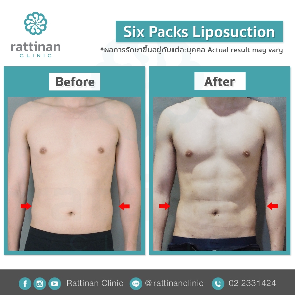 ดูดไขมันซิกแพค sixpack liposuction ที่รัตตินันท์ เมดิคคอล เซ็นเตอร์