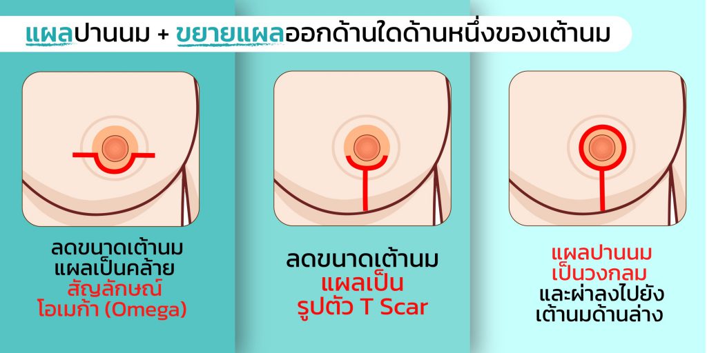 ผ่าตัดเต้านม ลดขนาดหน้าอก แผลปานนม