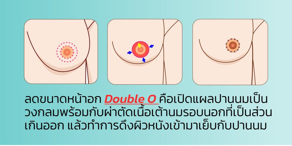 ผ่าตัด ลดขนาดหน้าอก แบบ Double O