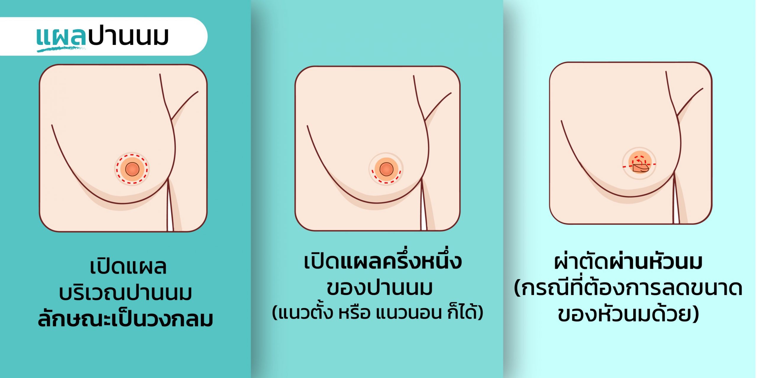 ศัลยกรรมทอม ผ่าตัดลดขนาดหน้าอก