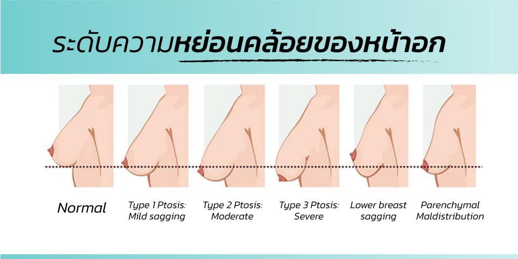 ศัลยกรรมนมทอม ผ่าตัด ลดขนาดเต้านม ความยืดหยุ่นของเต้านม