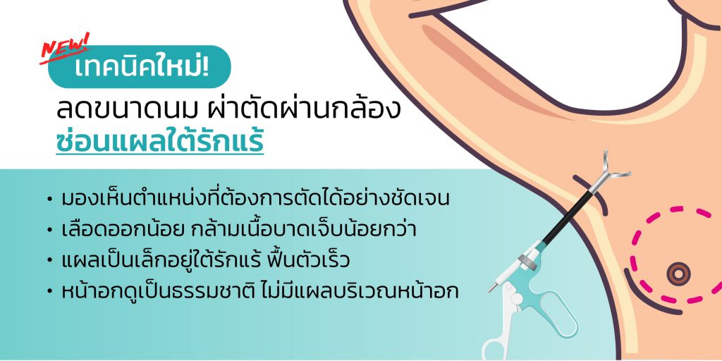 ลดขนาดหน้าอก เทคนิคใหม่ ส่องกล้องใต้รักแร้ ไร้แผลเป็นหน้าอก