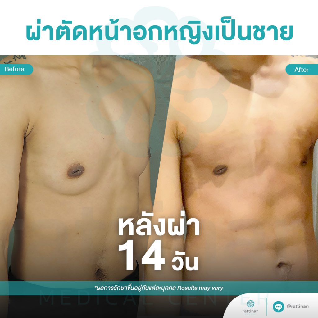 รีวิว ผ่าตัดหน้าอกหญิงเป็นชาย ตัดนมทอม ศัลยกรรมทอม ลดขนาดหน้าอก 1