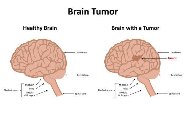 อาการปวดหัว เนื้องอกในสมอง