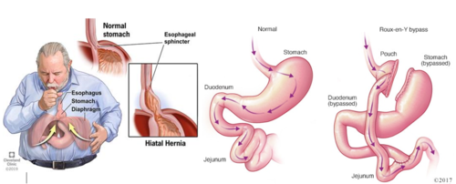 Dumping Syndrome รักษาอย่างไร