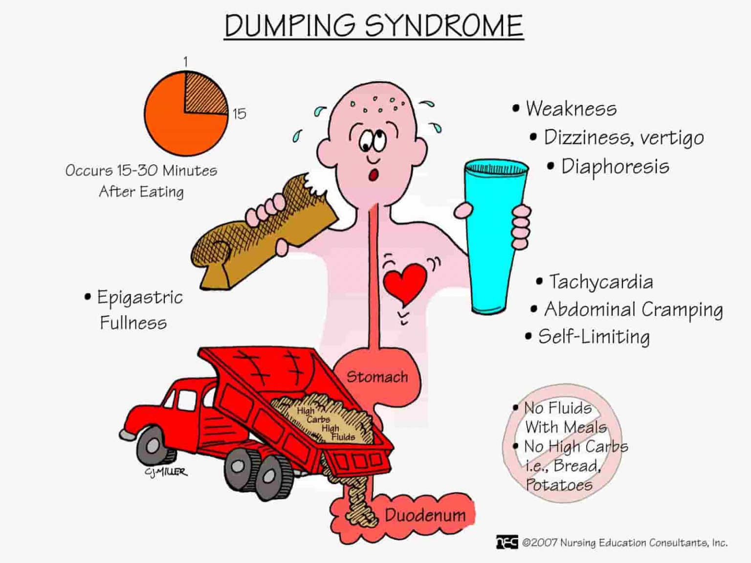 dumping-syndrome