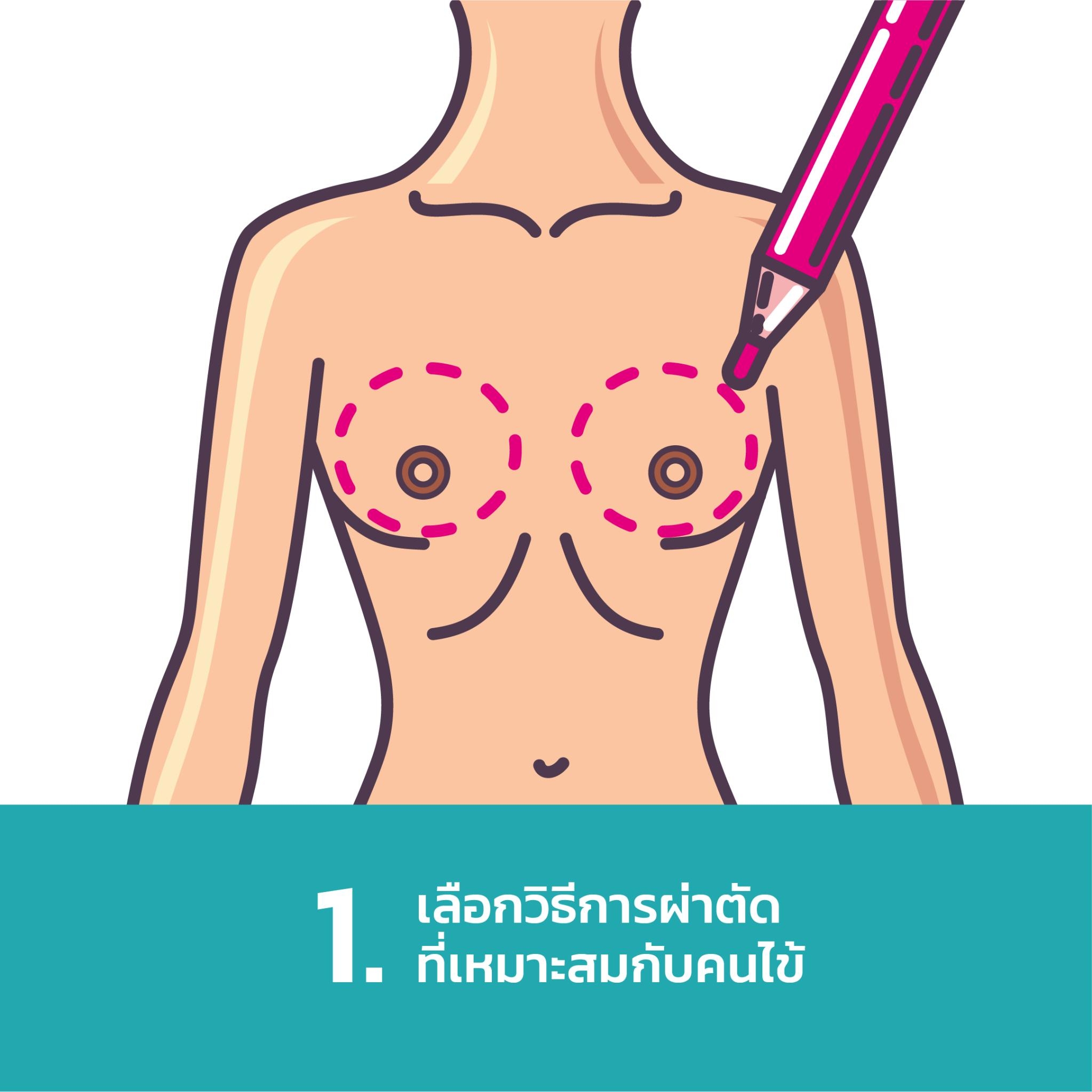 ขั้นตอน ตัดนมทอม ส่องกล้องใต้รักแร้